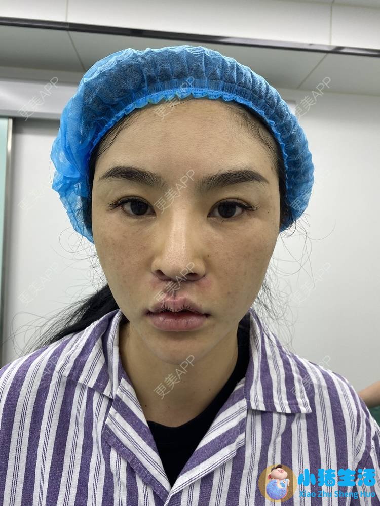 鼻子整形整容失败案例