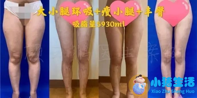 北京脂肪填充/吸脂医生排名前十哪个好？