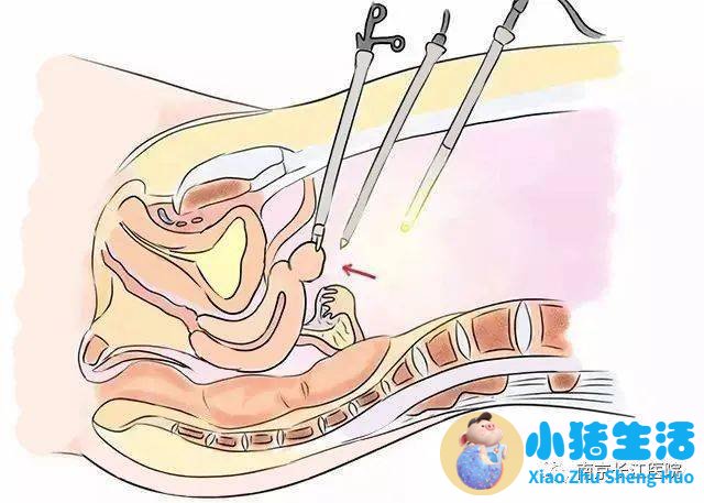 阴道微创手术后的注意事项