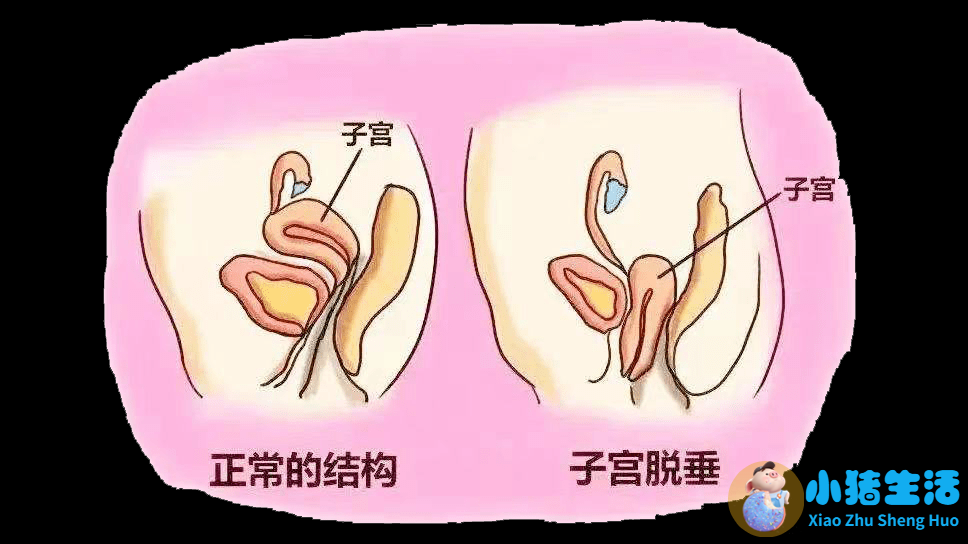 阴道微创手术后的注意事项