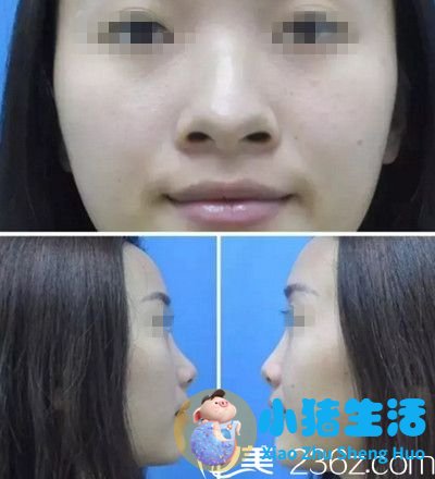 我在濮阳美林苑做鼻综合手术前