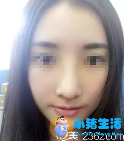 我在濮阳美林苑做鼻综合手术后7天