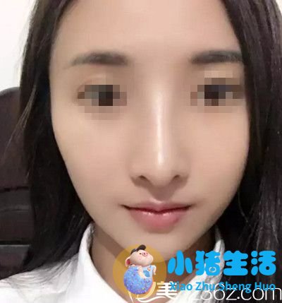 我在濮阳美林苑做鼻综合手术后9天