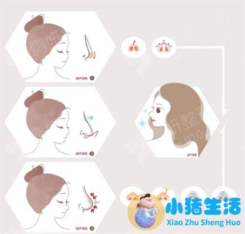 美林苑整形失败案例