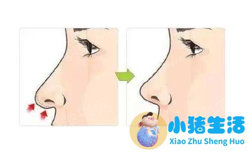 美林苑整形失败案例