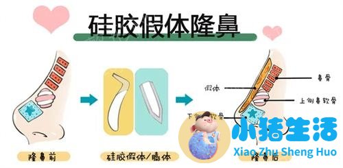 美林苑整形失败案例