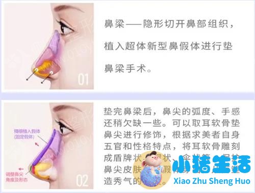 美林苑整形失败案例