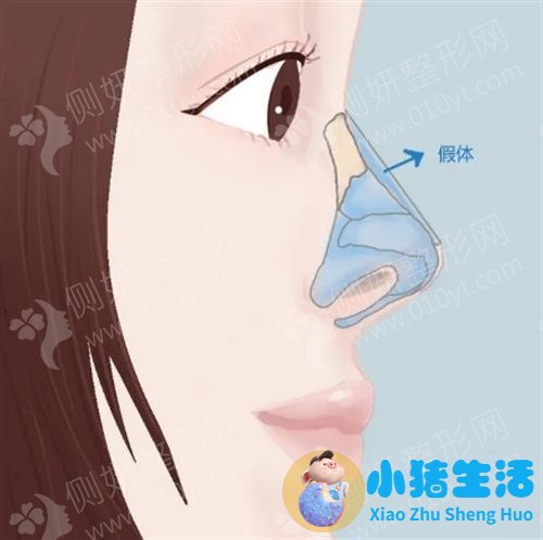 美林苑整形失败案例
