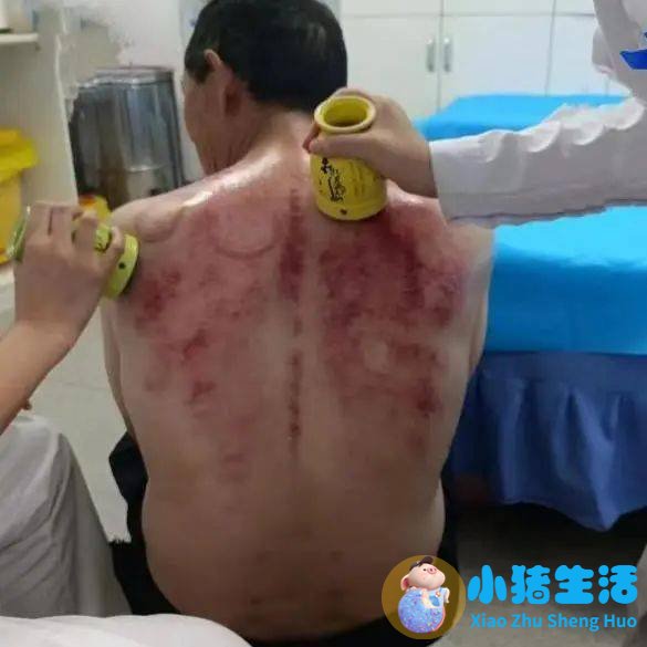 <strong>科普 | 中医特色疗法——温灸刮痧</strong>