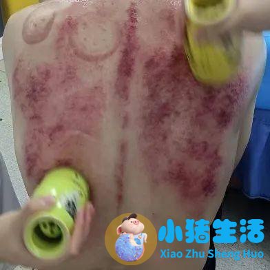 刮痧局部减肥