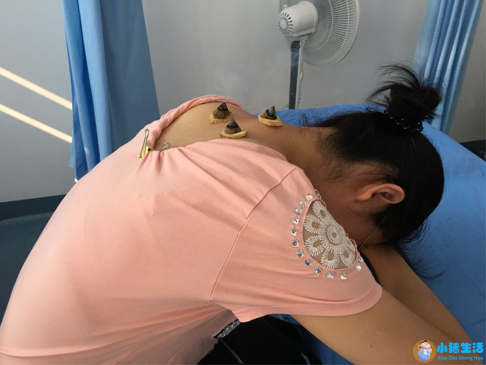 刮痧局部减肥
