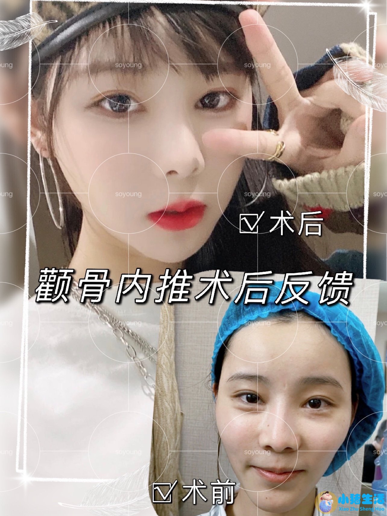 颧骨整容失败修复应该要注意哪些发布时