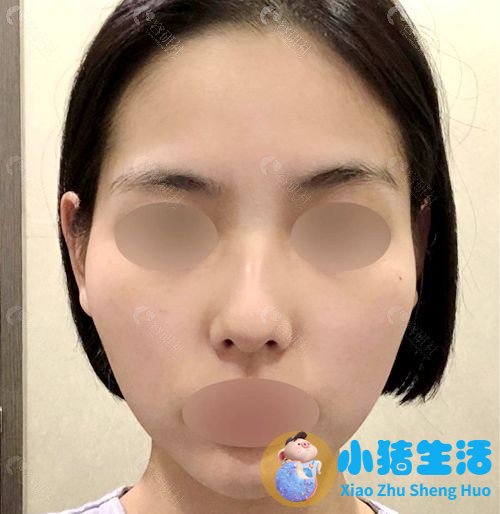 颧骨整形失败案例