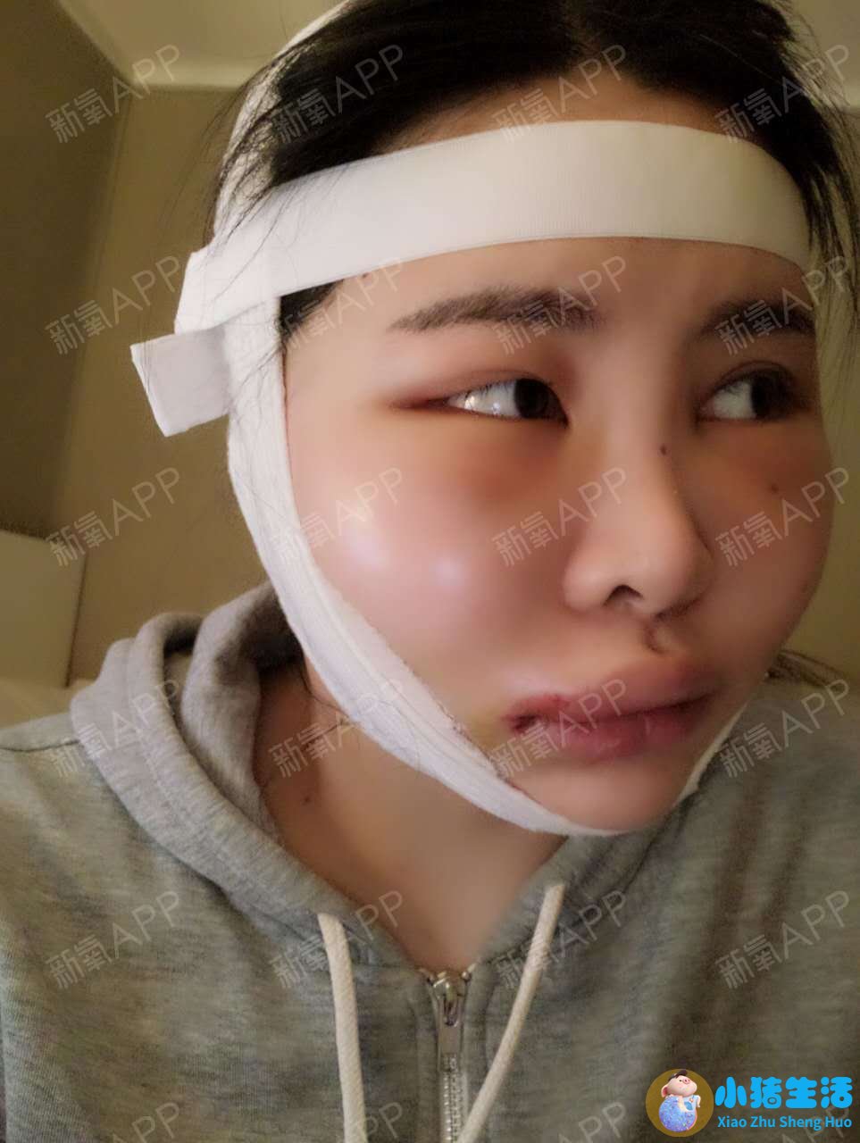 颧骨整形失败怎么办？