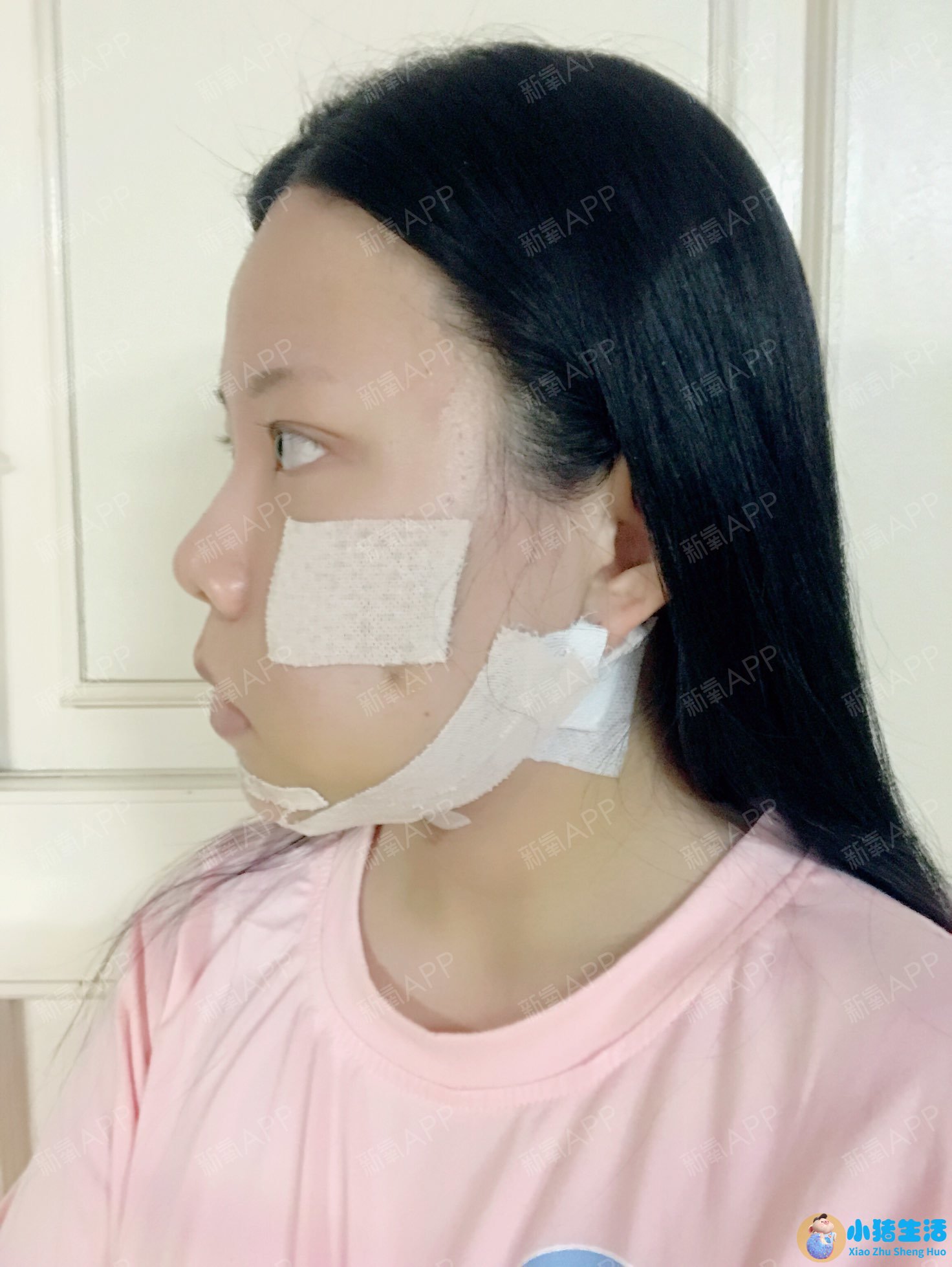 颧骨整形失败案例