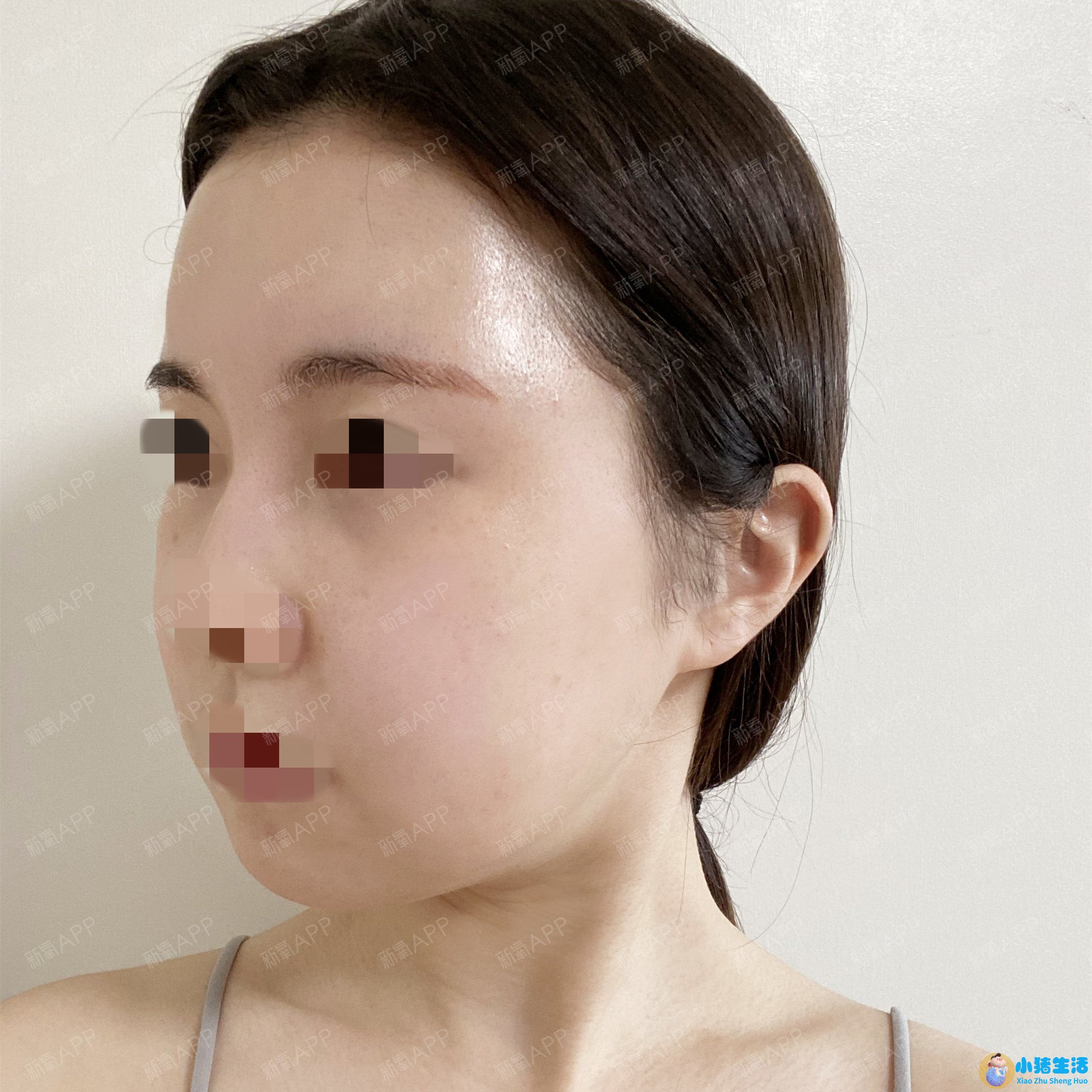 颧骨整形失败案例