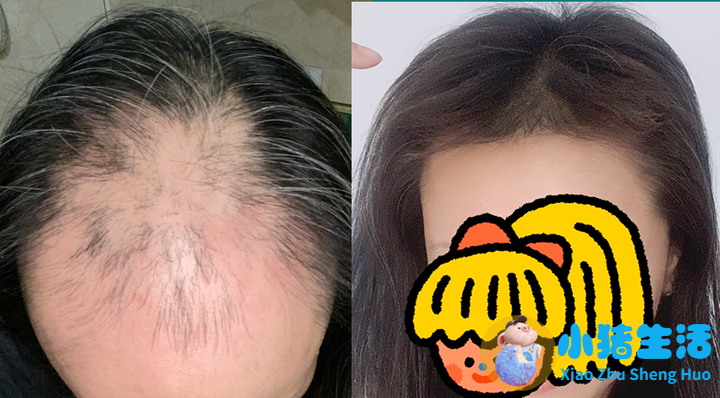 梳头时老是掉头发