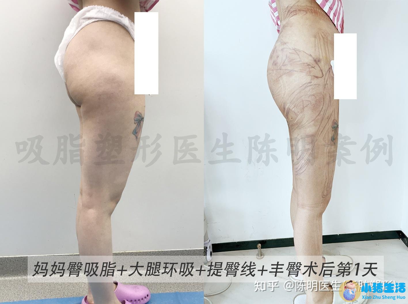 臀部吸脂问诊藝星