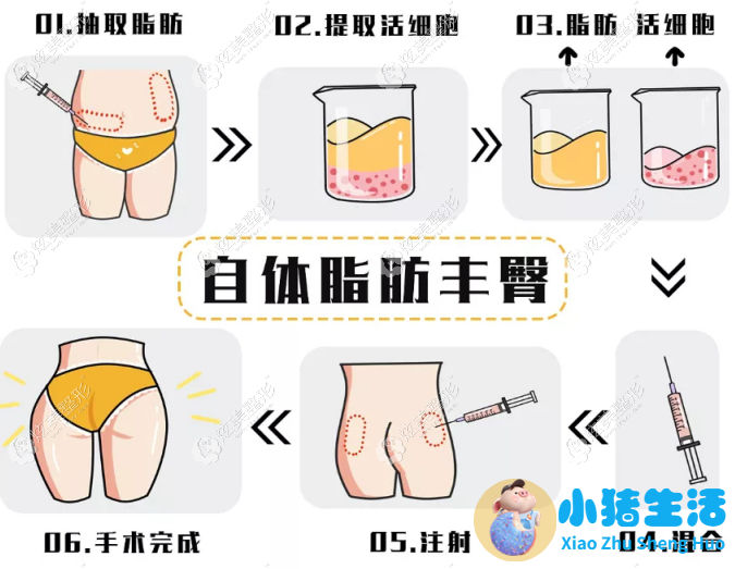 臀部吸脂问诊藝星