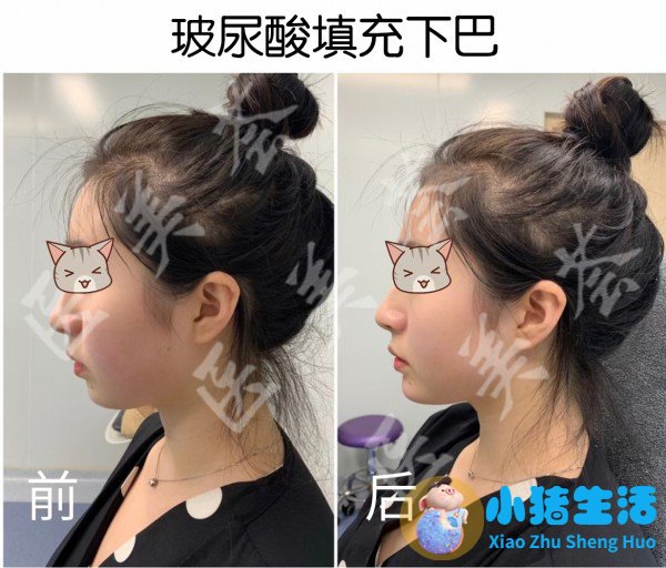 长春医大医院打玻尿酸多少钱一针