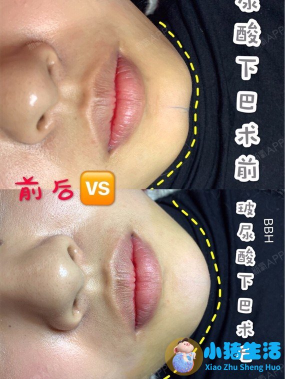 长春医大医院打玻尿酸多少钱一针