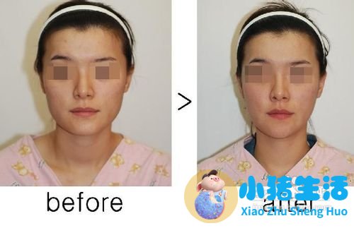 伊美尚整形毁容案例