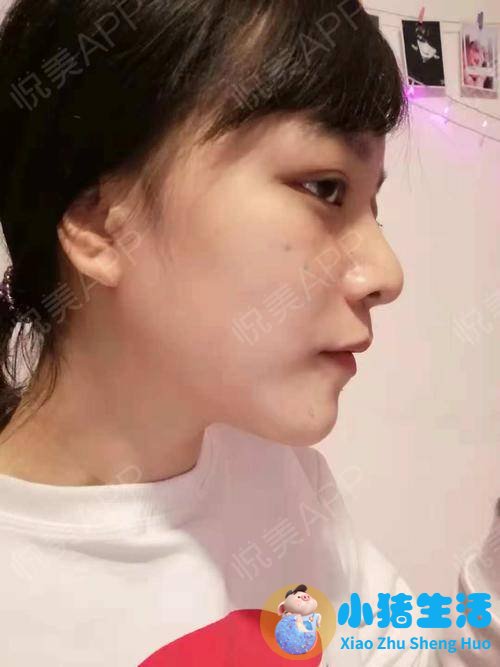 伊美尚整形毁容案例