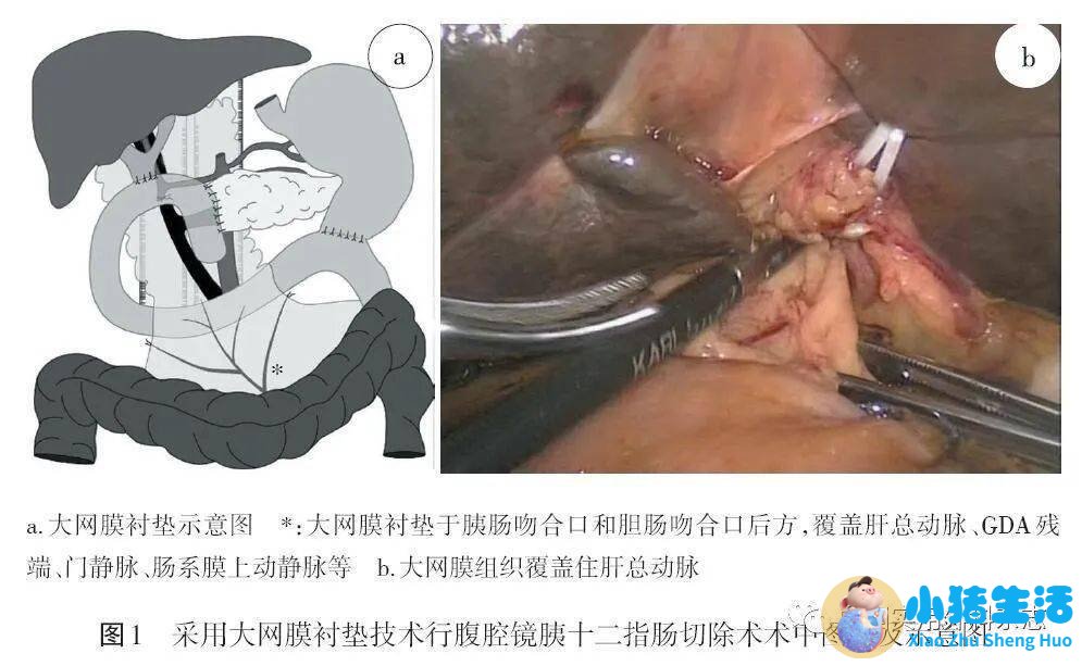 新生儿肠吻合术后喂养