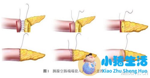 新生儿肠吻合术后喂养
