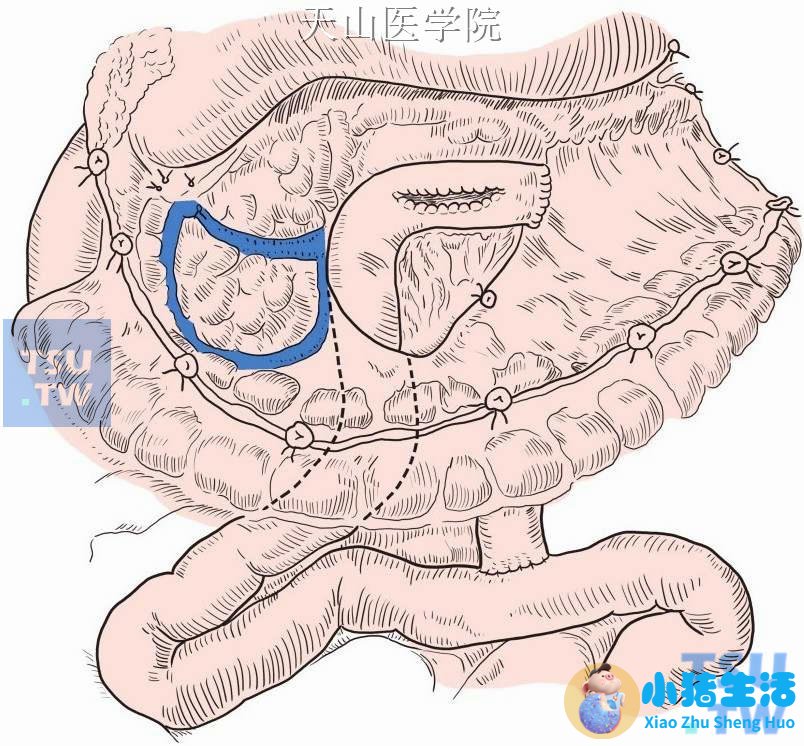 新生儿肠吻合术后喂养
