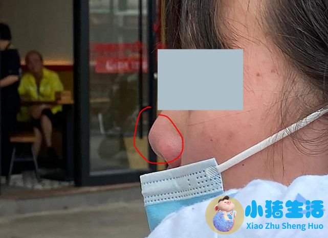 伊美尚整形毁容案例