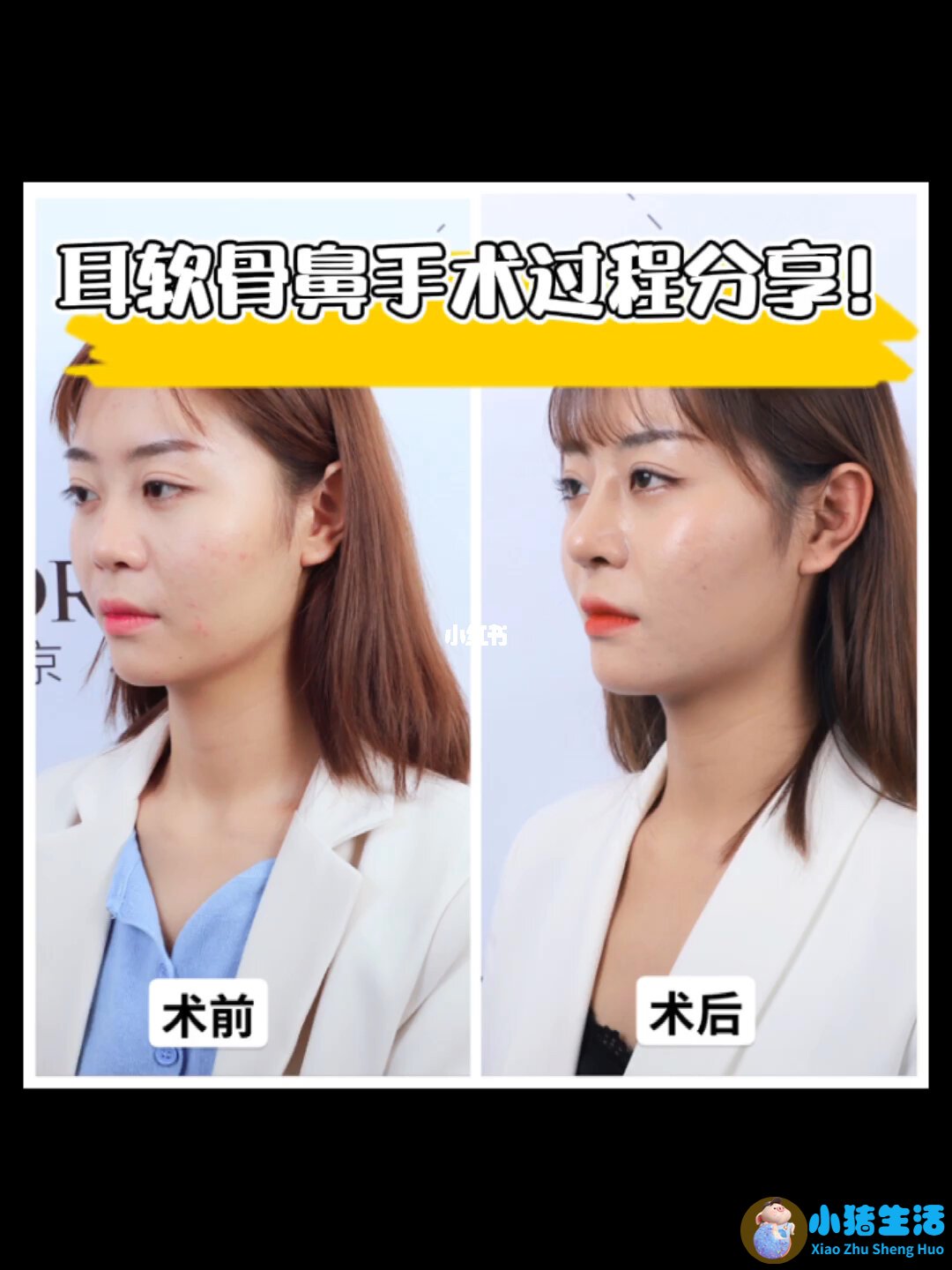 上海柏荟 整形失败案例
