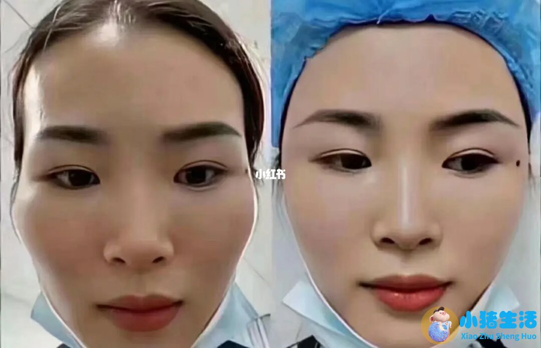 玻尿酸注射过程是怎样的？需知关于玻尿