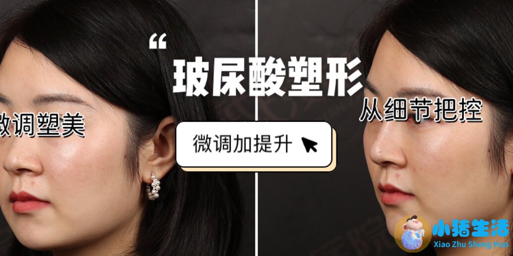 长春医大医院打玻尿酸多少钱一针