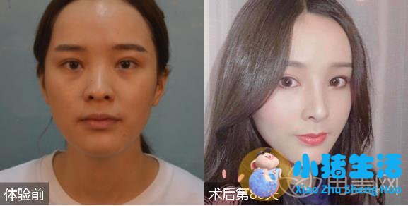 伊美尚整形毁容案例