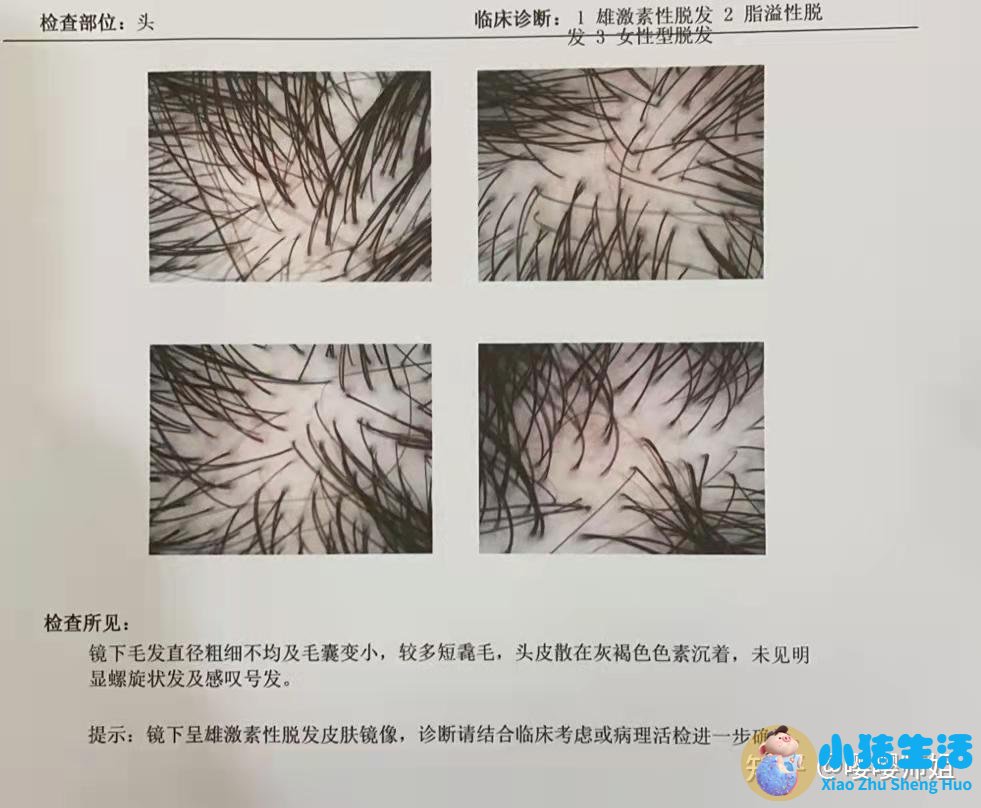 防脱生发最好的产品