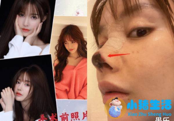 伊美尚整形毁容案例