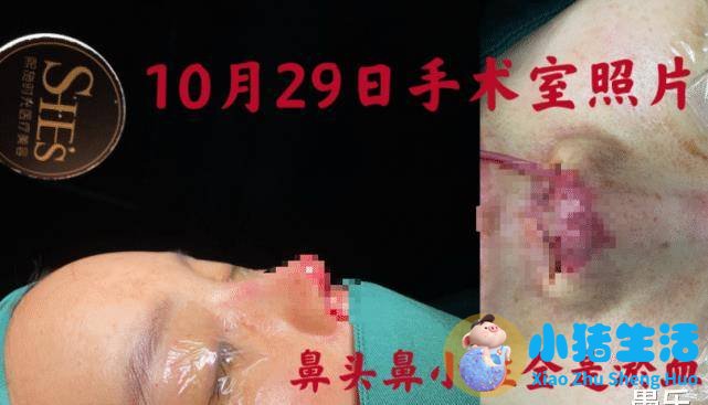 伊美尚整形毁容案例