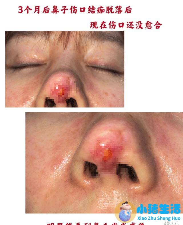 伊美尚整形毁容案例