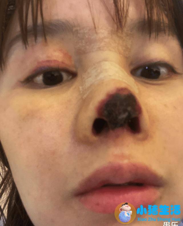 伊美尚整形毁容案例