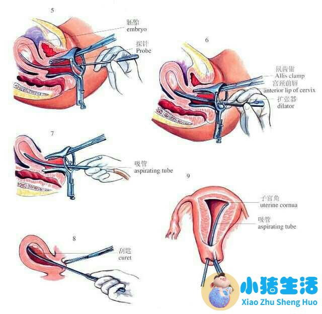 怀孕做人流要多久可以做掉