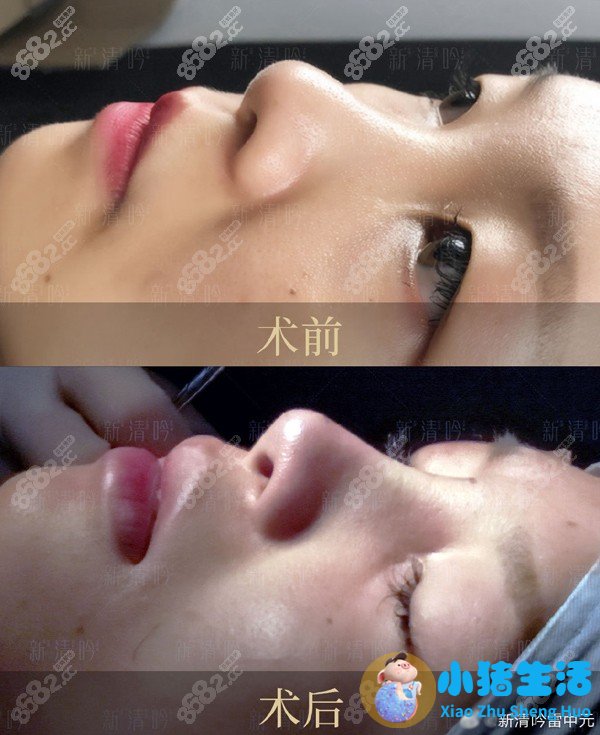射极峰膨体+自体耳软骨隆鼻前后对比