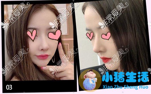鼻孔整形真实案例