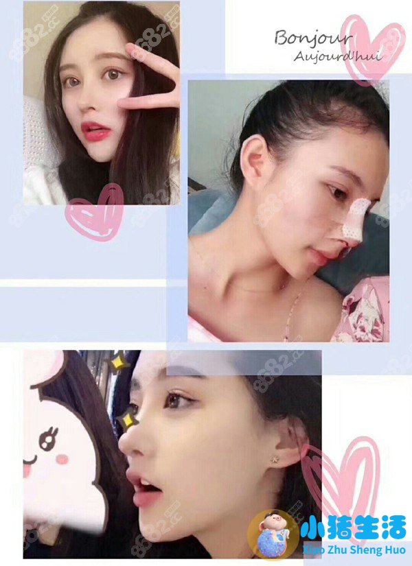 韩士生科三段隆鼻恢复过程