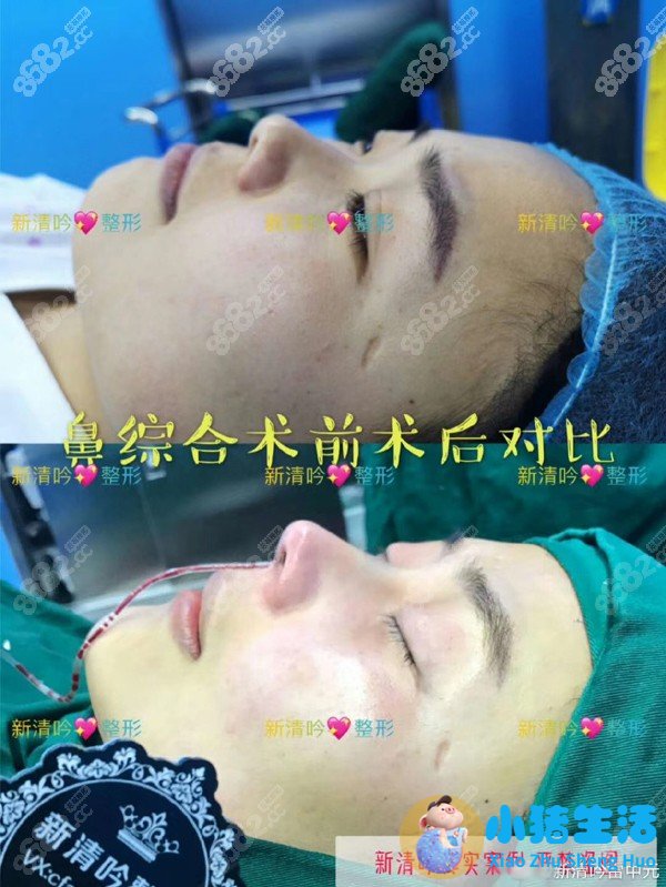 自体肋软骨鼻综合术前术后对比