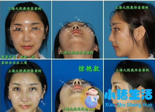 鼻孔整形真实案例