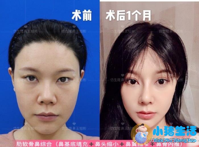 鼻孔整形真实案例