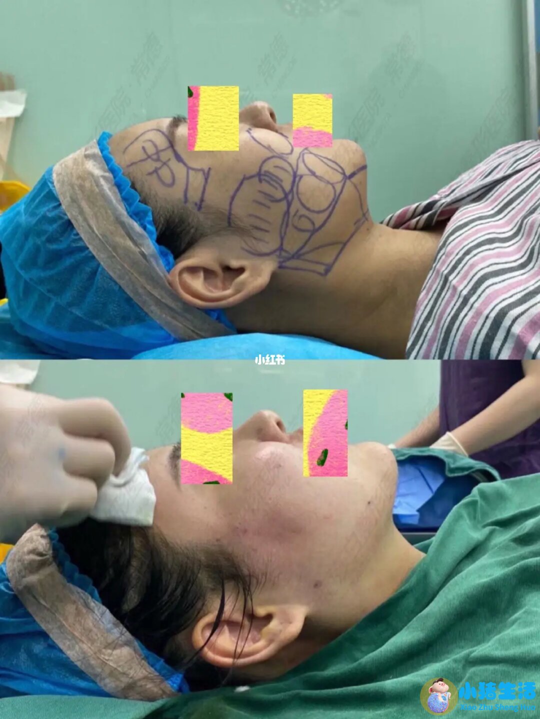 双下巴抽脂多长时间手术