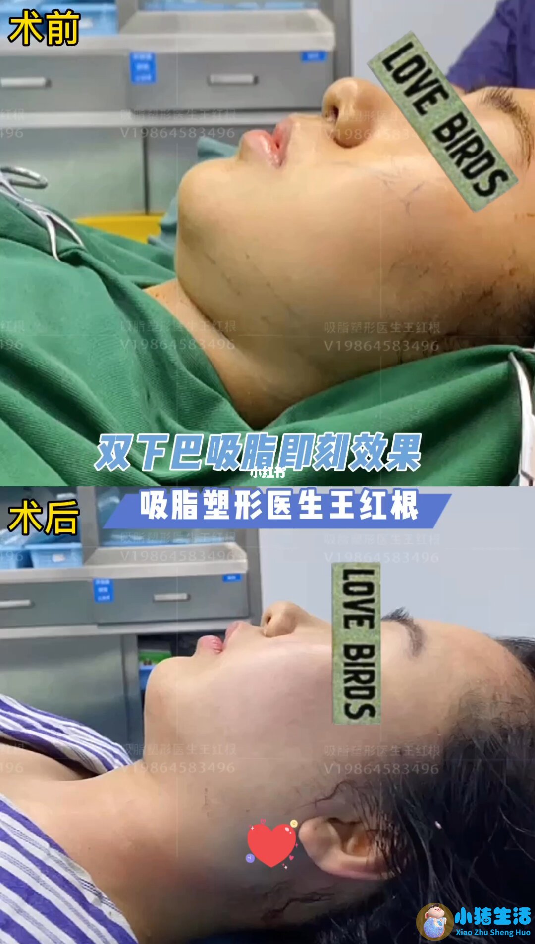 双下巴抽脂多长时间手术