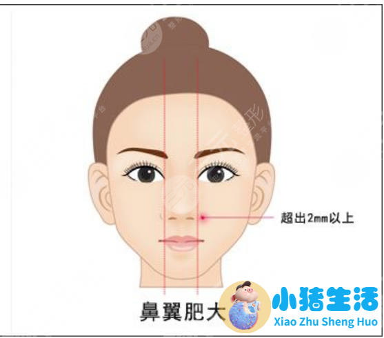 鼻翼过宽整容真人案例果恢复过程